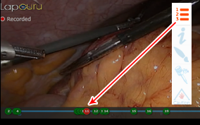 lapGuru Steps of Surgery
