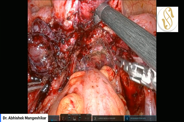 Robotic Myomectomy + Adenomyomectomy with NOSE Segmental Resection