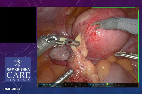 Total Robotic Hysterectomy for Large Fibroid